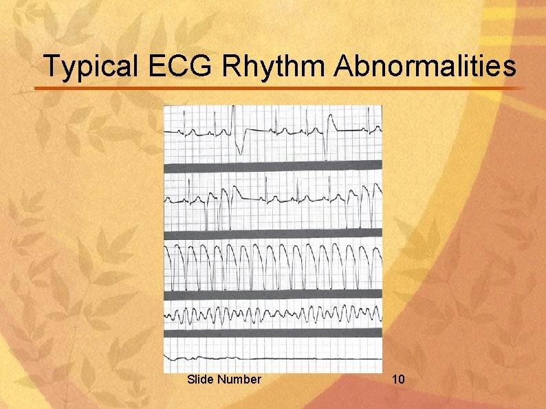 Typical ECG Rhythm Abnormalities Slide Number 10 