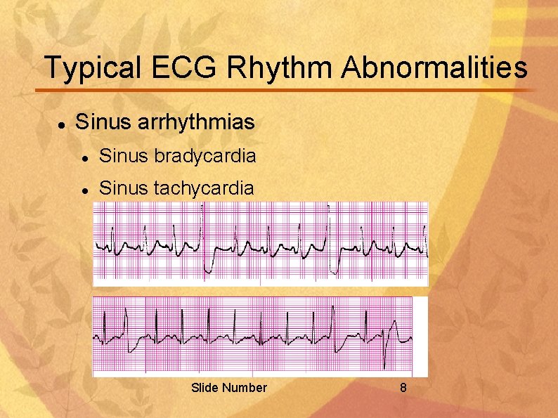 Typical ECG Rhythm Abnormalities Sinus arrhythmias Sinus bradycardia Sinus tachycardia Slide Number 8 