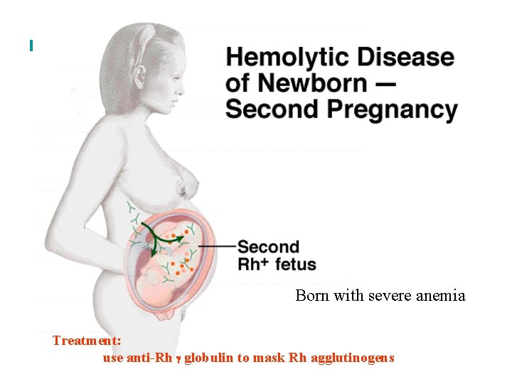 Born with severe anemia Treatment: use anti-Rh globulin to mask Rh agglutinogens 