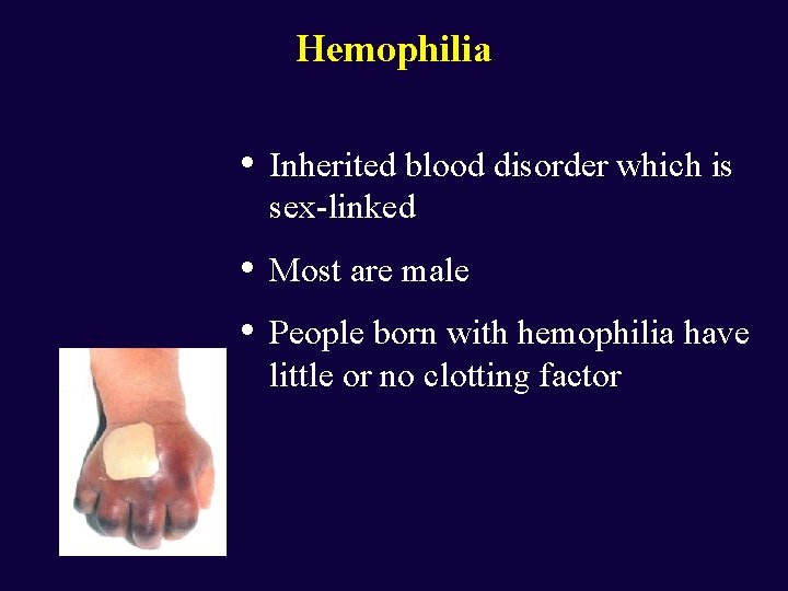 Hemophilia • Inherited blood disorder which is sex-linked • • Most are male People