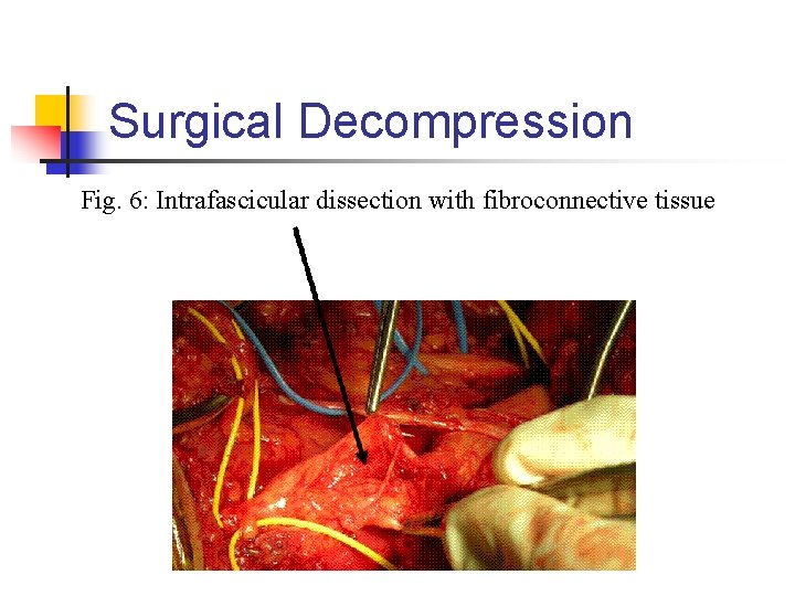 Surgical Decompression Fig. 6: Intrafascicular dissection with fibroconnective tissue 