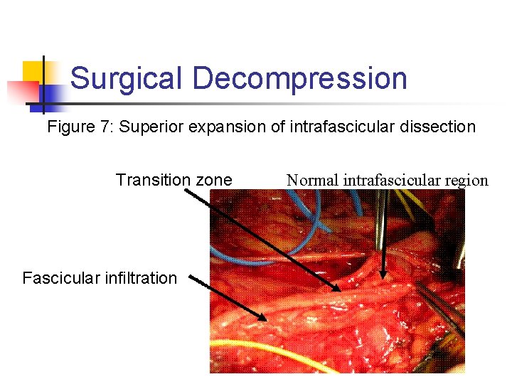 Surgical Decompression Figure 7: Superior expansion of intrafascicular dissection Transition zone Fascicular infiltration Normal