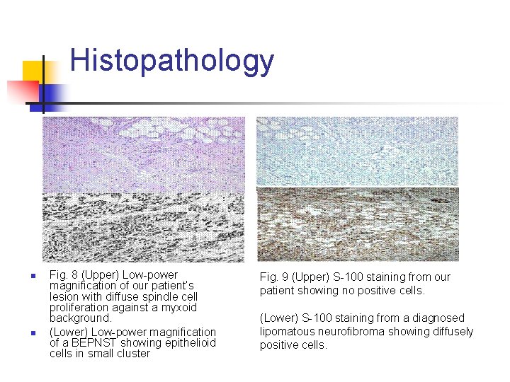 Histopathology n n Fig. 8 (Upper) Low-power magnification of our patient’s lesion with diffuse
