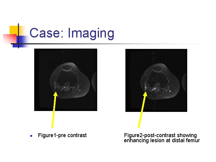 Case: Imaging n Figure 1 -pre contrast Figure 2 -post-contrast showing enhancing lesion at