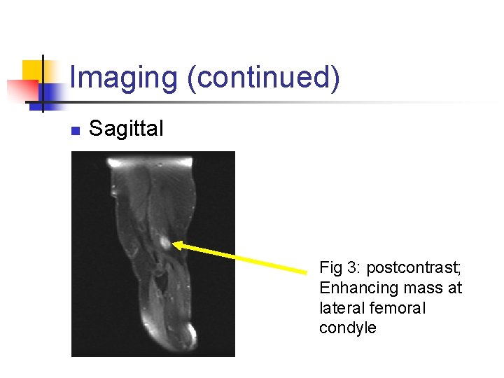 Imaging (continued) n Sagittal Fig 3: postcontrast; Enhancing mass at lateral femoral condyle 