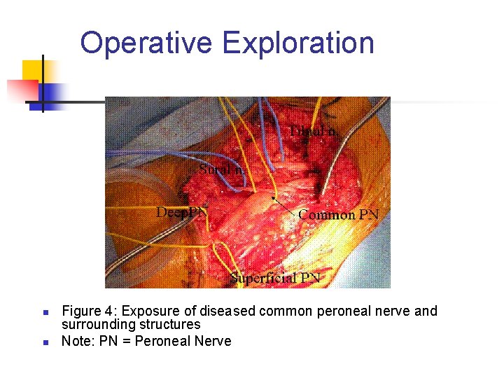 Operative Exploration n n Figure 4: Exposure of diseased common peroneal nerve and surrounding