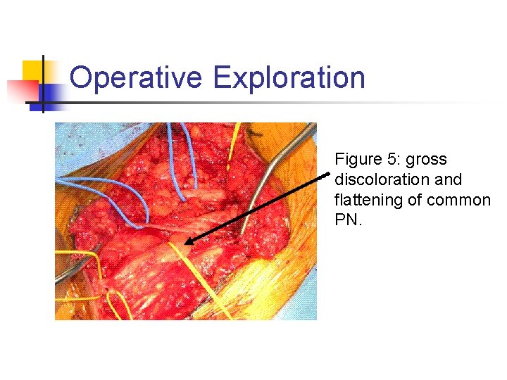Operative Exploration Figure 5: gross discoloration and flattening of common PN. 
