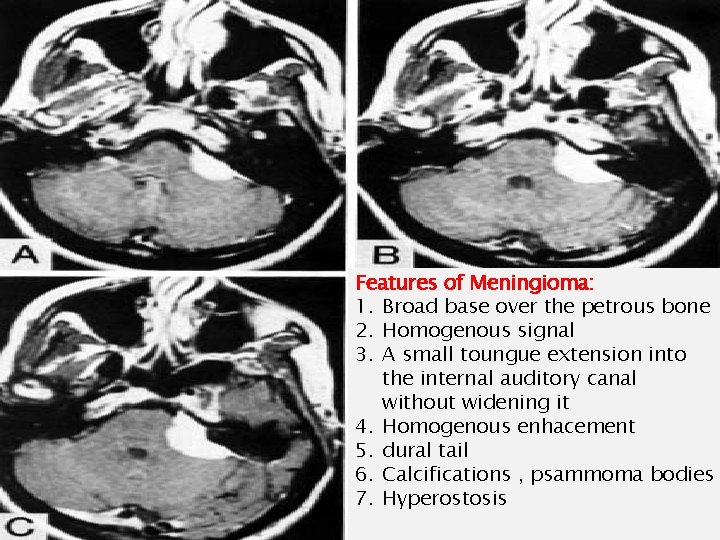 Features of Meningioma: 1. Broad base over the petrous bone 2. Homogenous signal 3.