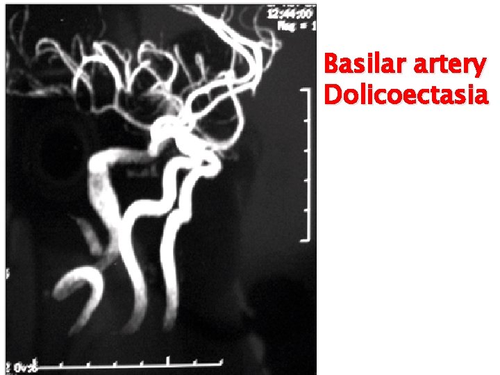 Basilar artery Dolicoectasia 