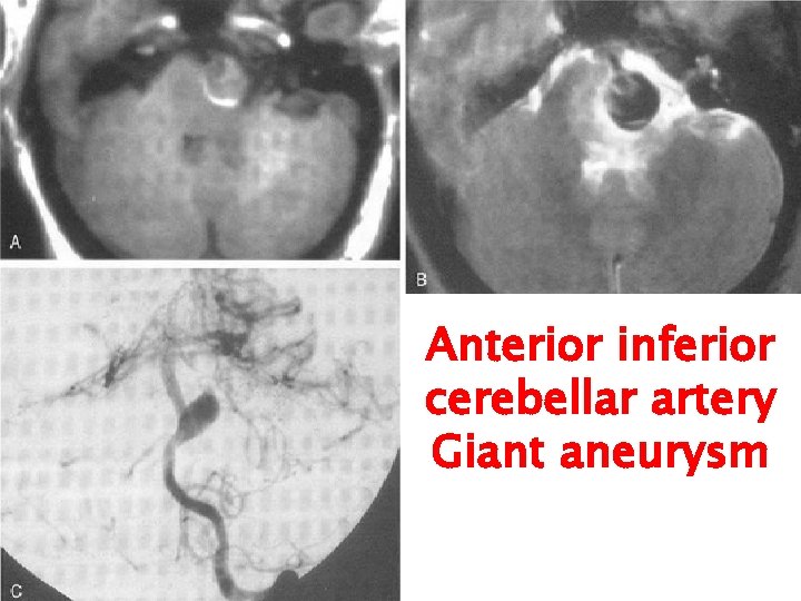 Anterior inferior cerebellar artery Giant aneurysm 