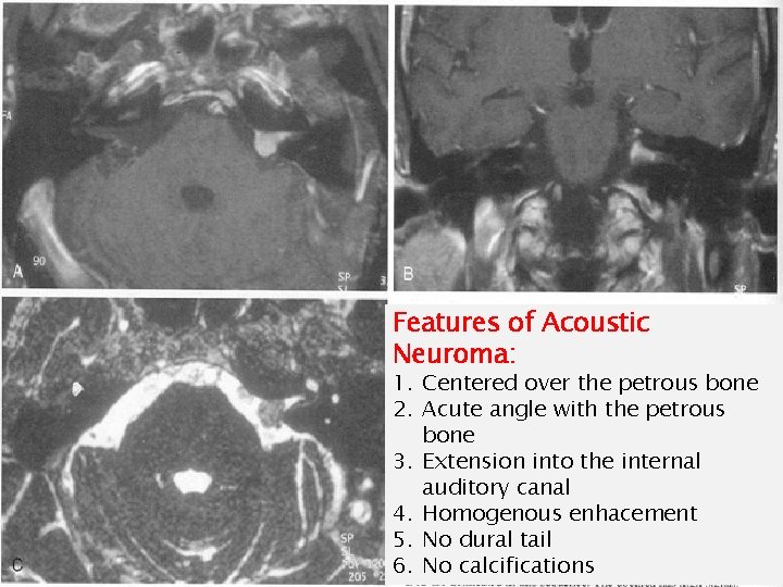 Features of Acoustic Neuroma: 1. Centered over the petrous bone 2. Acute angle with