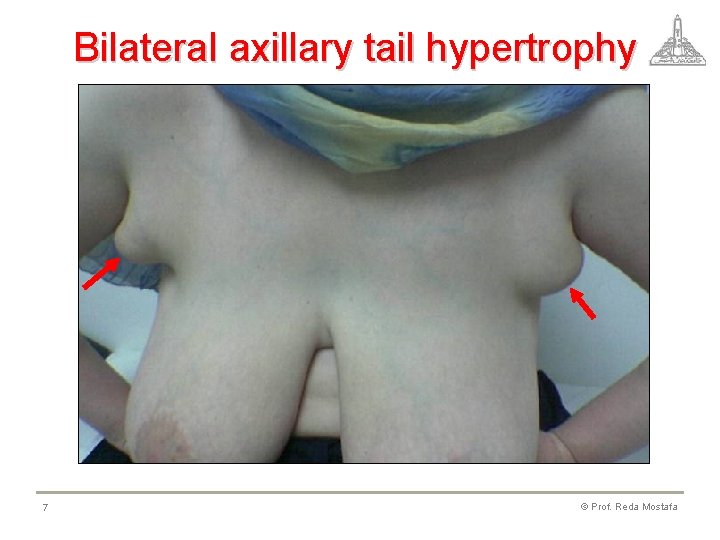 Bilateral axillary tail hypertrophy 7 © Prof. Reda Mostafa 