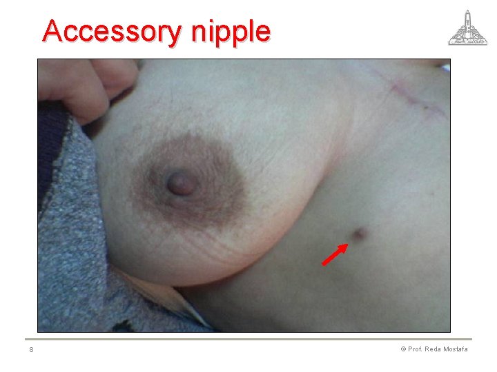 Accessory nipple 8 © Prof. Reda Mostafa 