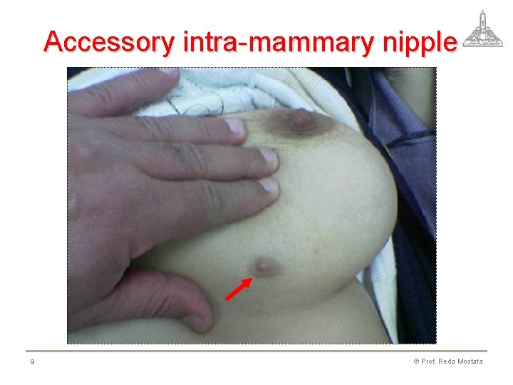 Accessory intra-mammary nipple 9 © Prof. Reda Mostafa 