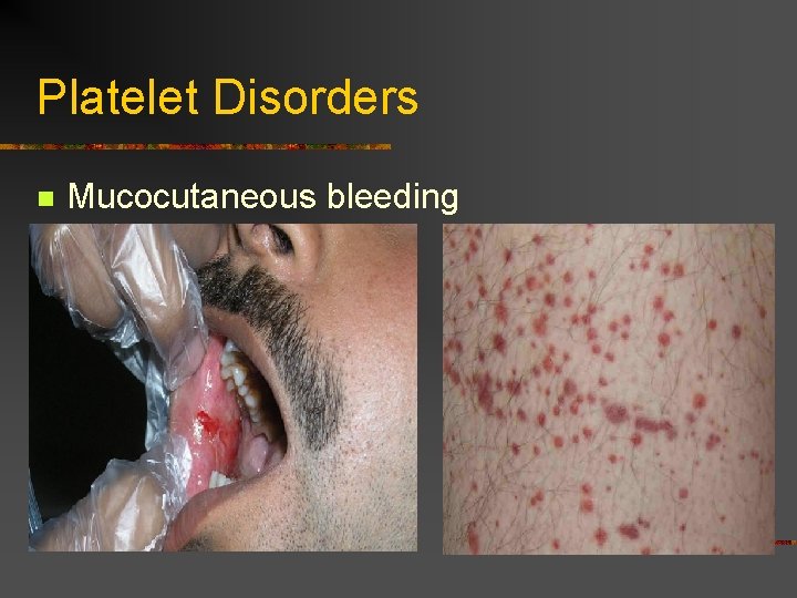 Platelet Disorders n Mucocutaneous bleeding 