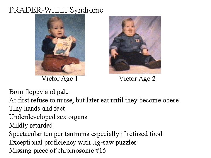 PRADER-WILLI Syndrome Victor Age 1 Victor Age 2 Born floppy and pale At first