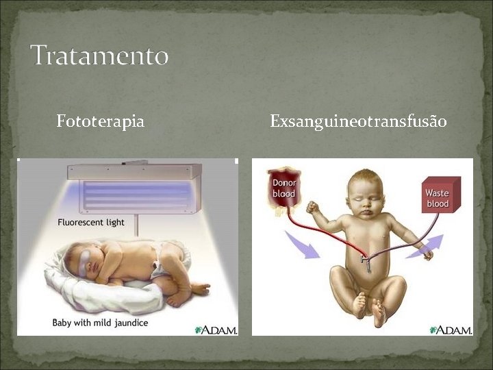 Fototerapia Exsanguineotransfusão 