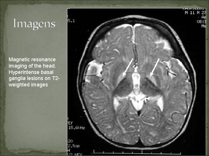 Magnetic resonance imaging of the head. Hyperintense basal ganglia lesions on T 2 weighted