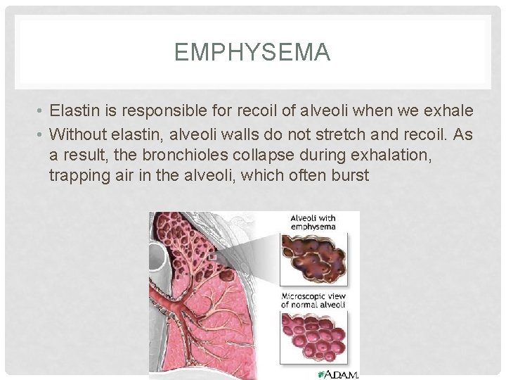EMPHYSEMA • Elastin is responsible for recoil of alveoli when we exhale • Without