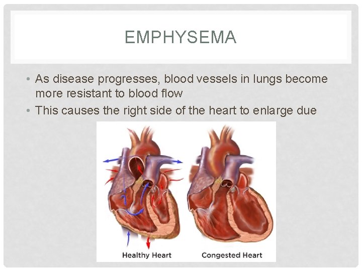 EMPHYSEMA • As disease progresses, blood vessels in lungs become more resistant to blood