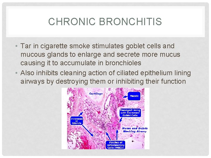 CHRONIC BRONCHITIS • Tar in cigarette smoke stimulates goblet cells and mucous glands to