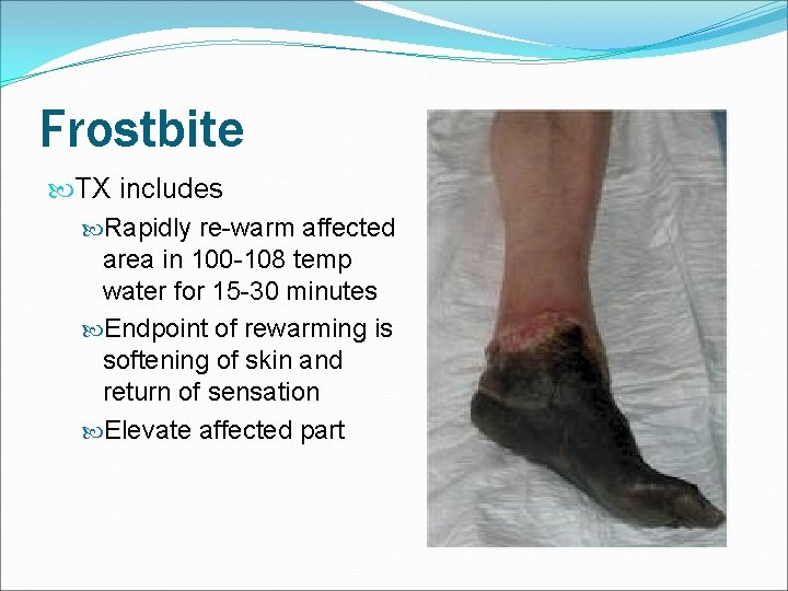 Frostbite TX includes Rapidly re-warm affected area in 100 -108 temp water for 15