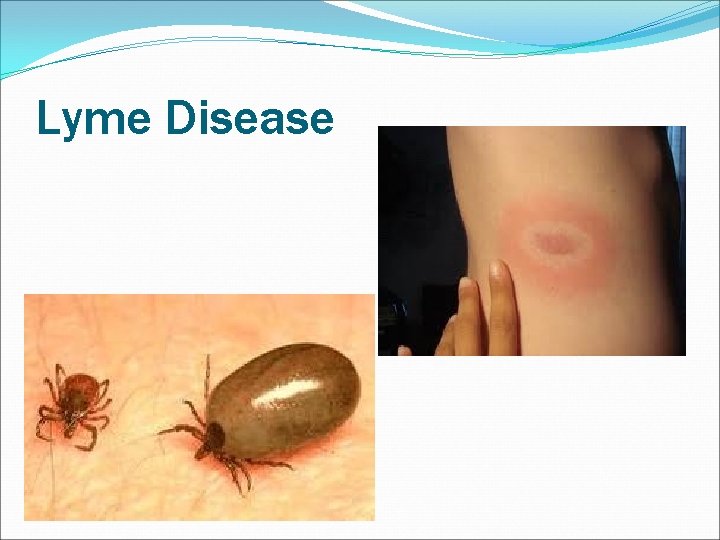 Lyme Disease 