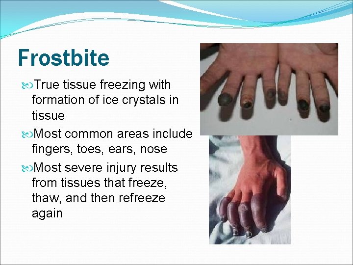 Frostbite True tissue freezing with formation of ice crystals in tissue Most common areas