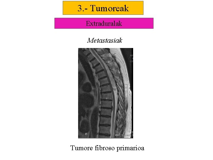 3. - Tumoreak Extraduralak Metastasiak Tumore fibroso primarioa 