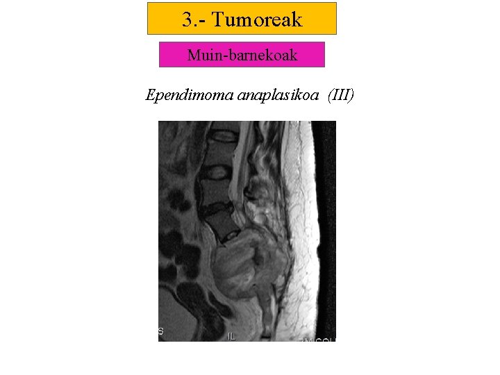 3. - Tumoreak Muin-barnekoak Ependimoma anaplasikoa (III) 