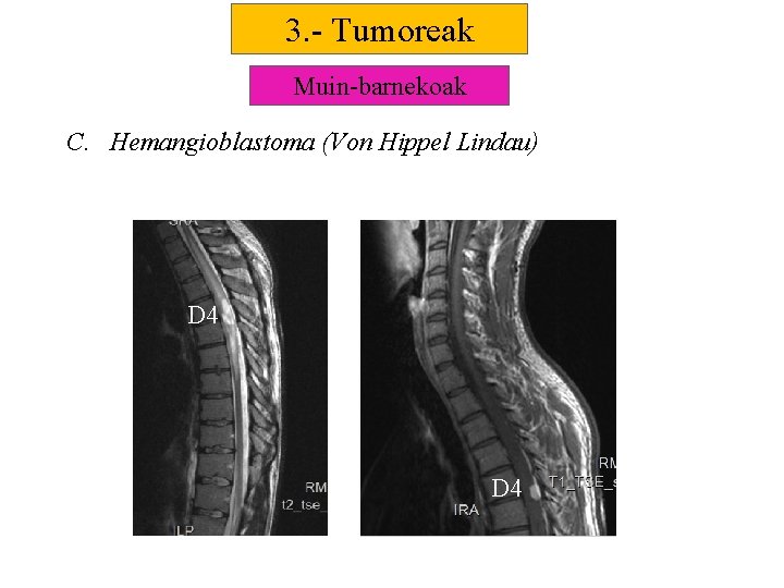 3. - Tumoreak Muin-barnekoak C. Hemangioblastoma (Von Hippel Lindau) D 4 