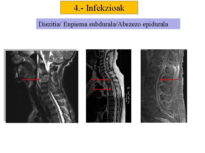 4. - Infekzioak Diszitia/ Enpiema subdurala/Abszezo epidurala 