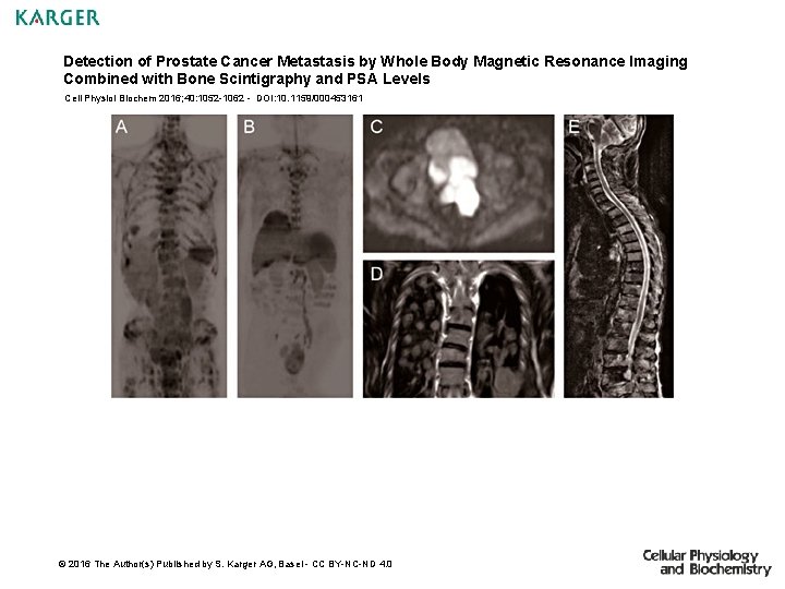 Detection of Prostate Cancer Metastasis by Whole Body
