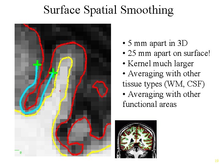 Surface Spatial Smoothing • 5 mm apart in 3 D • 25 mm apart