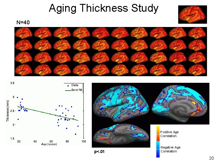 Aging Thickness Study N=40 Positive Age Correlation p<. 01 Negative Age Correlation 20 