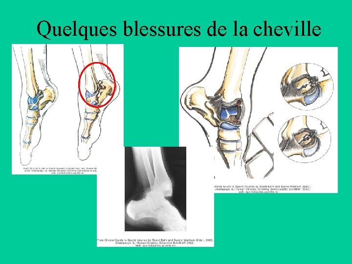 Quelques blessures de la cheville 