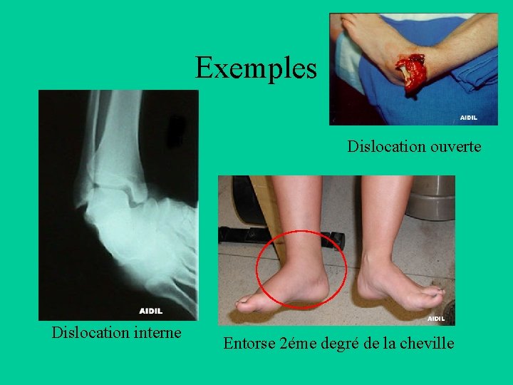 Exemples Dislocation ouverte Dislocation interne Entorse 2éme degré de la cheville 