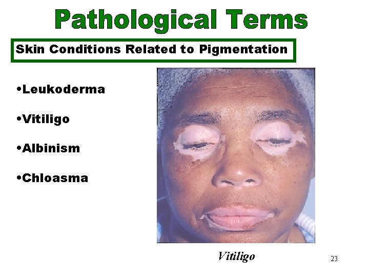 Skin Conditions Related to Pigmentation • Leukoderma • Vitiligo • Albinism • Chloasma Vitiligo