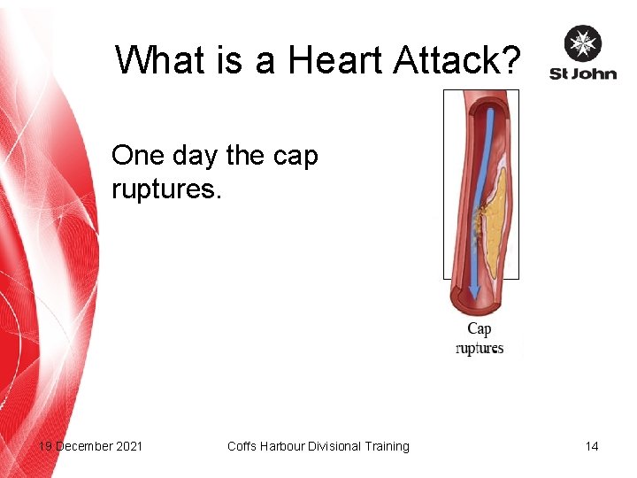 What is a Heart Attack? One day the cap ruptures. 19 December 2021 Coffs