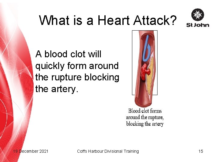 What is a Heart Attack? A blood clot will quickly form around the rupture
