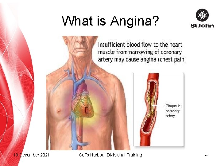 What is Angina? 19 December 2021 Coffs Harbour Divisional Training 4 