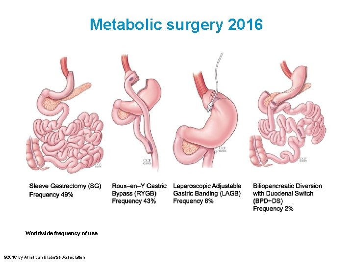 Metabolic surgery 2016 Worldwide frequency of use © 2016 by American Diabetes Association 