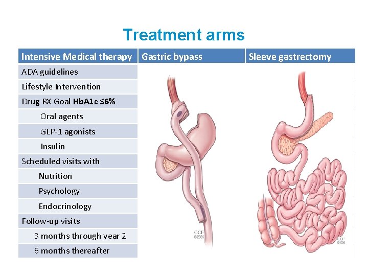 Treatment arms Intensive Medical therapy Gastric bypass ADA guidelines Lifestyle Intervention Drug RX Goal