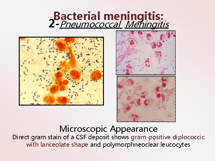 Bacterial meningitis: 2 -Pneumococcal Meningitis Microscopic Appearance Direct gram stain of a CSF deposit