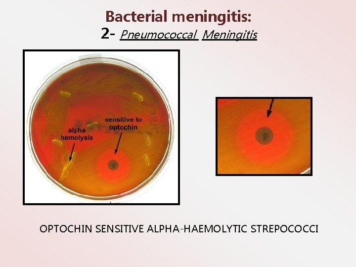 Bacterial meningitis: 2 - Pneumococcal Meningitis OPTOCHIN SENSITIVE ALPHA-HAEMOLYTIC STREPOCOCCI 