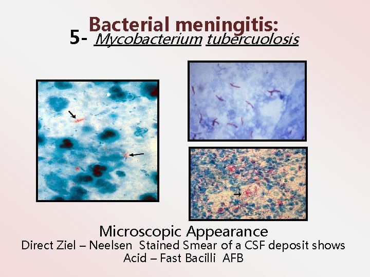 Bacterial meningitis: 5 - Mycobacterium tubercuolosis Microscopic Appearance Direct Ziel – Neelsen Stained Smear