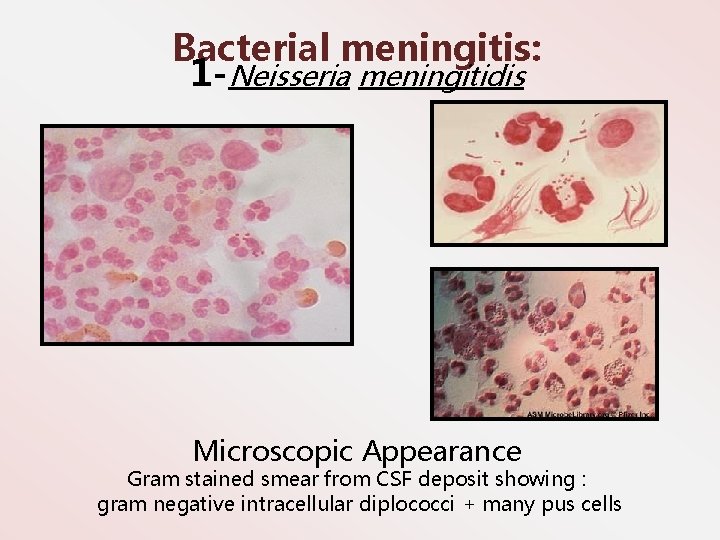 Bacterial meningitis: 1 -Neisseria meningitidis Microscopic Appearance Gram stained smear from CSF deposit showing