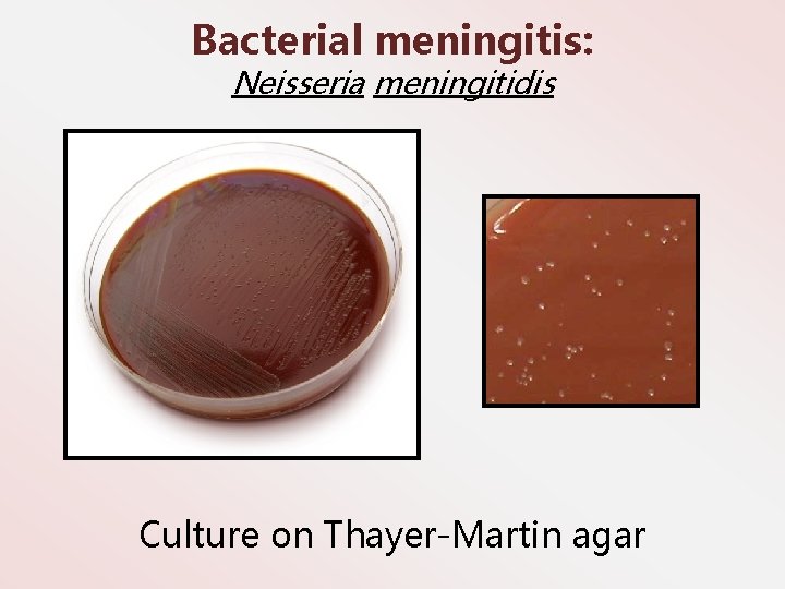 Bacterial meningitis: Neisseria meningitidis Culture on Thayer-Martin agar 