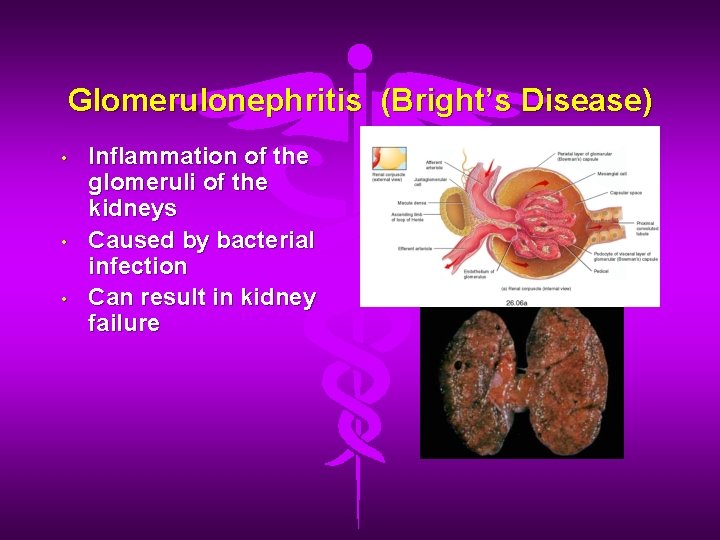Glomerulonephritis (Bright’s Disease) • • • Inflammation of the glomeruli of the kidneys Caused