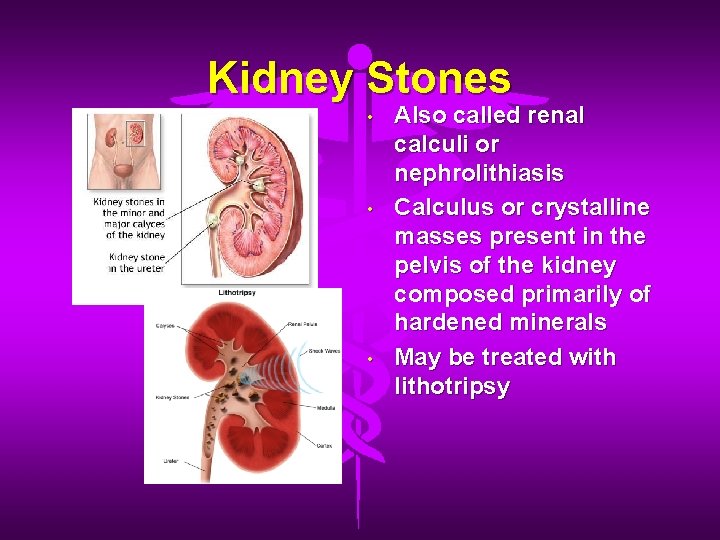 Kidney Stones • • • Also called renal calculi or nephrolithiasis Calculus or crystalline